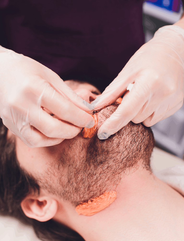 Dermatologist providing beard growth therapy to a patient seeking fuller beard development at a skin and hair clinic in Chennai.