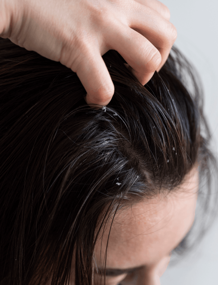 Dermatologist providing oily scalp treatment to a patient at a skin and hair clinic in Chennai.