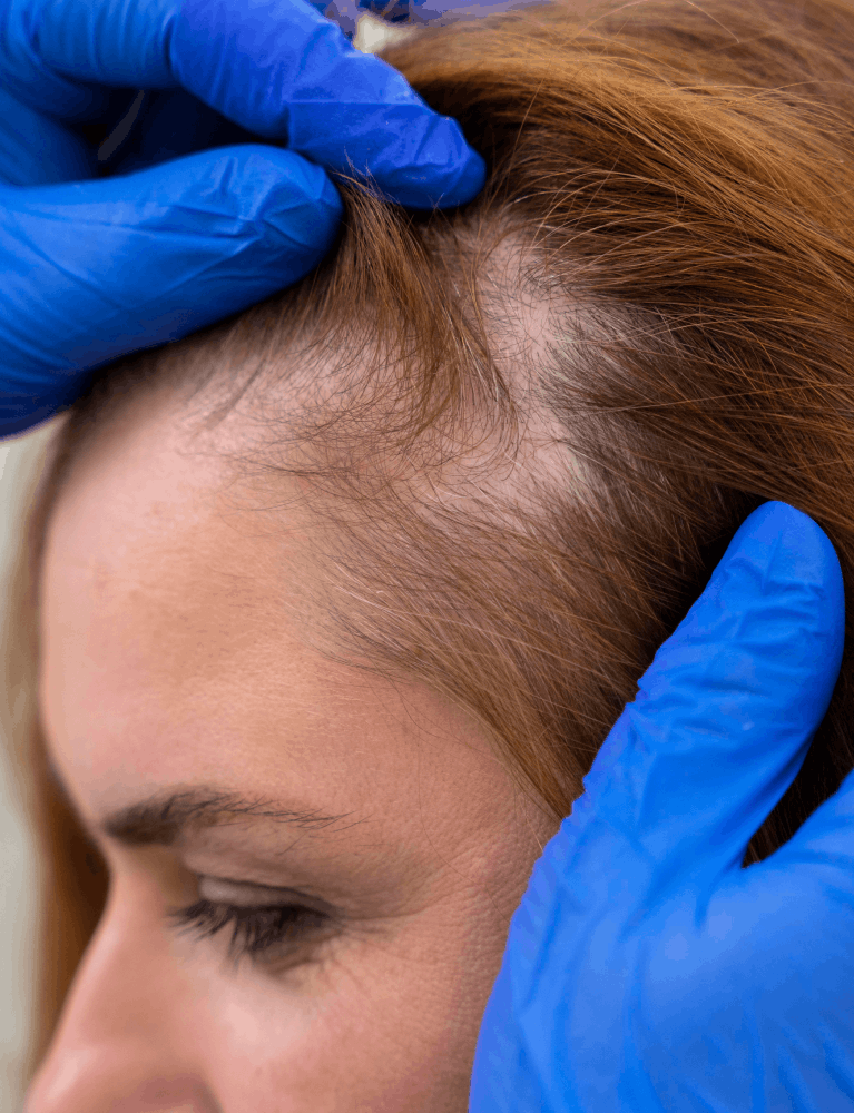 Dermatologist providing pattern hair loss treatment to a patient experiencing male or female pattern baldness at a skin and hair clinic in Chennai.