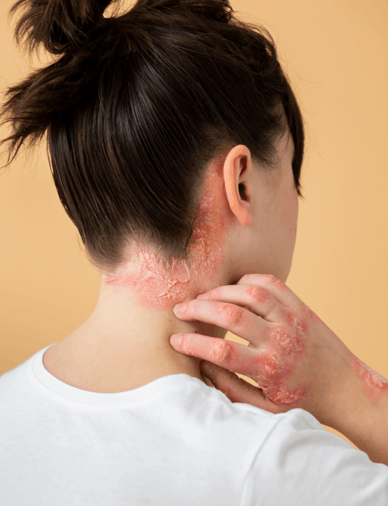 Dermatologist treating psoriasis-affected skin on a patient at a skin clinic in Chennai.