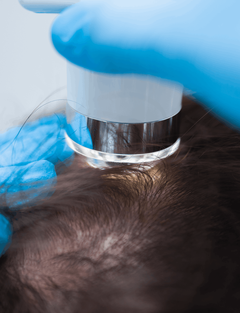 Dermatologist performing scalp micropigmentation treatment on a patient with hair thinning at a skin and hair clinic in Chennai.