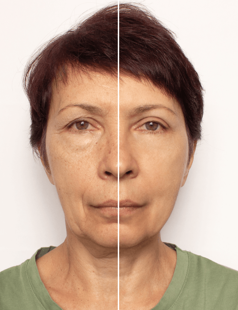 Dermatologist performing skin tightening treatment for sagging skin on a patient at a skin clinic in Chennai.