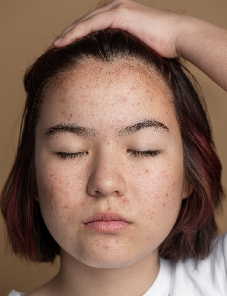 Dermatologist performing Milia Removal Treatment in Chennai to safely remove milia, improve skin texture, and restore a clear, healthy complexion.