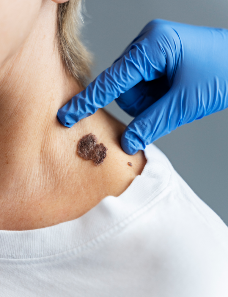 Dermatologist performing Skin Tag Removal Treatment in Chennai to safely remove skin tags using advanced dermatology procedures with minimal discomfort and scarring.