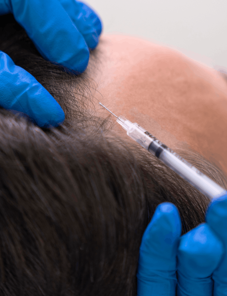Dermatologist performing PRP hair therapy on a patient experiencing hair loss at a skin and hair clinic in Chennai.